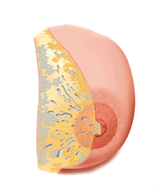 go to breast disorders