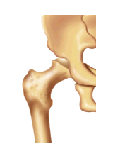 go to hip disorders