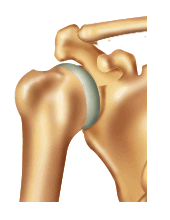 go to shoulder joint disorders